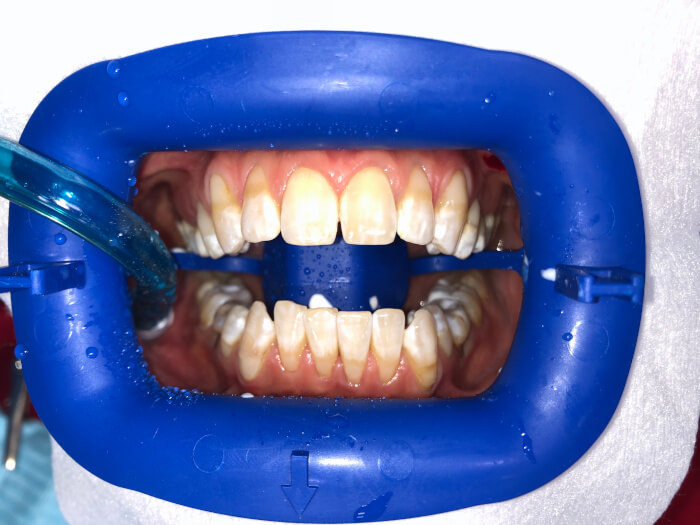 Отбеливание зубов тольятти zoom 4 зубная щетка braun vitality купить