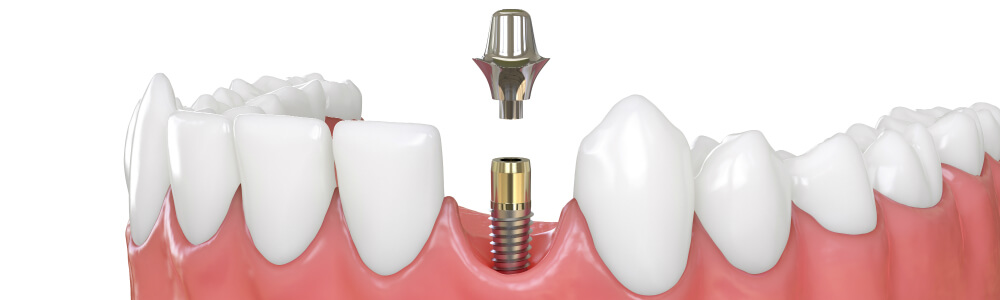 Зубные Накладки На 32 Передних И Жевательных Зуба
