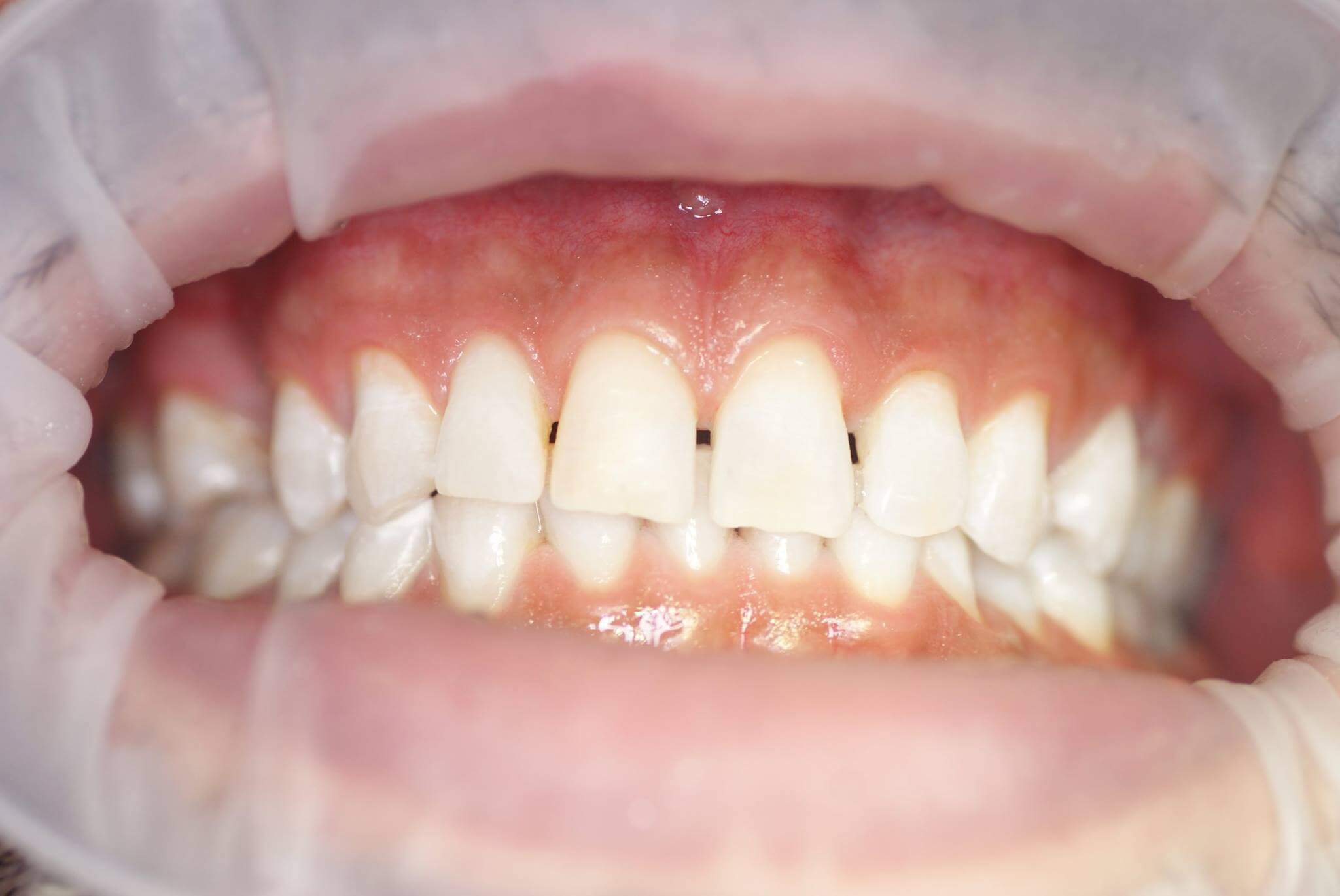 Результат отбеливания зубов системой Opalescence Boost