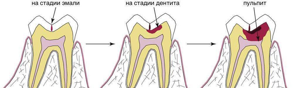 Лечение каналов молочных зубов1