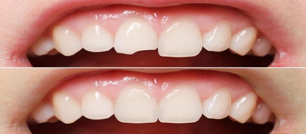 Восстановление зубов пломбой 1