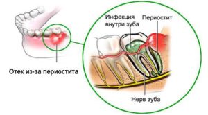 Периостит челюсти